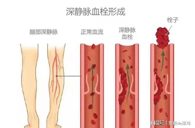 血博鱼体育app官网下载官方版栓来临手脚知道！再三提醒：手脚博鱼体育app官网下载官方登录有4种表现或是血管堵了(图3)